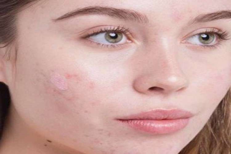 Best Acne Treatment In Ludhiana Dr Shikha Aggarwal 4764224