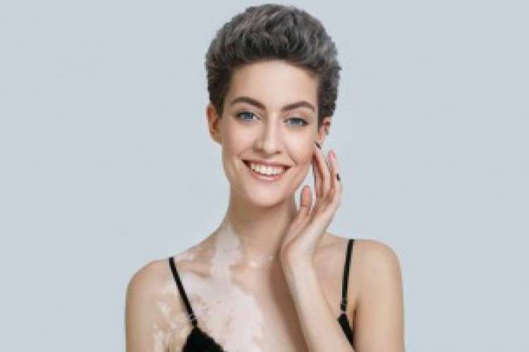 Best Clinic For Vitiligo Treatment In Ludhiana 250884