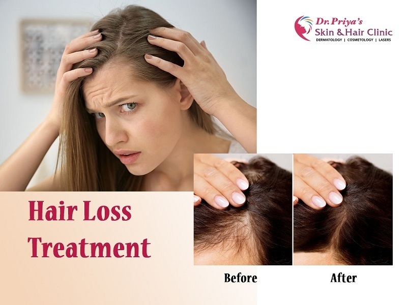 Best Hair Loss Treatment Clinics In Bangalore   Get Results Now 17302642613