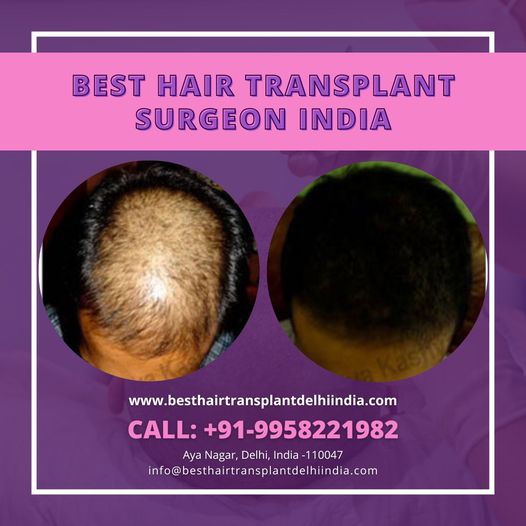 Best Hair Transplant In Delhi 16672856110