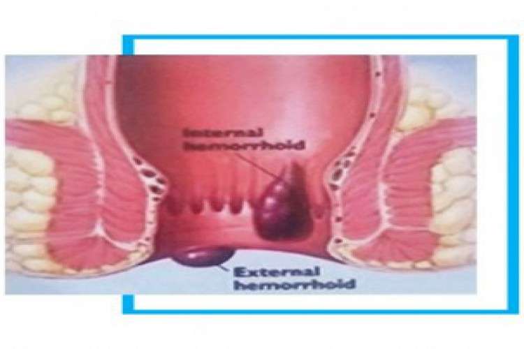 Best Treatment For Piles Haemorrhoidectomy In New Delhi 9110805