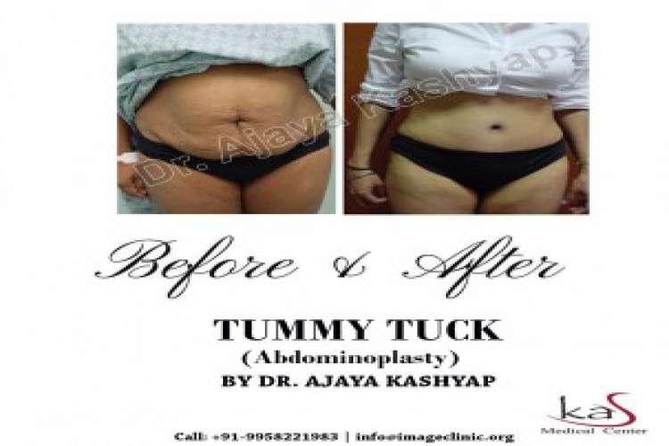 Best Tummy Tuck Surgeon Cost In South Delhi 3174431