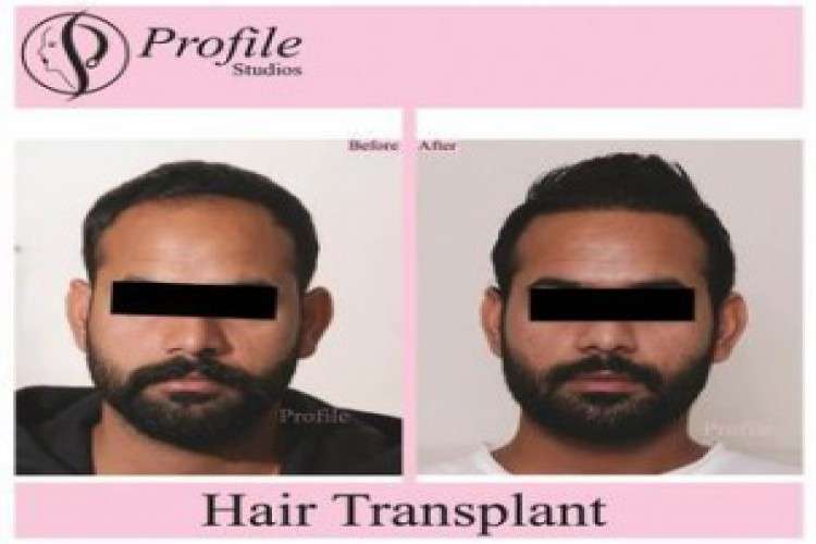 Cost Of Hair Transplant In Punjab 8517224