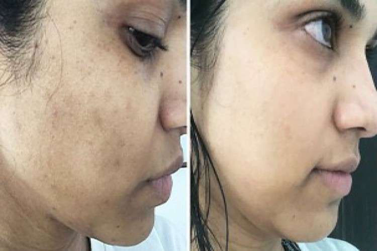 Dark Spot Treatment In Hyderabad And Bangalore 8736920