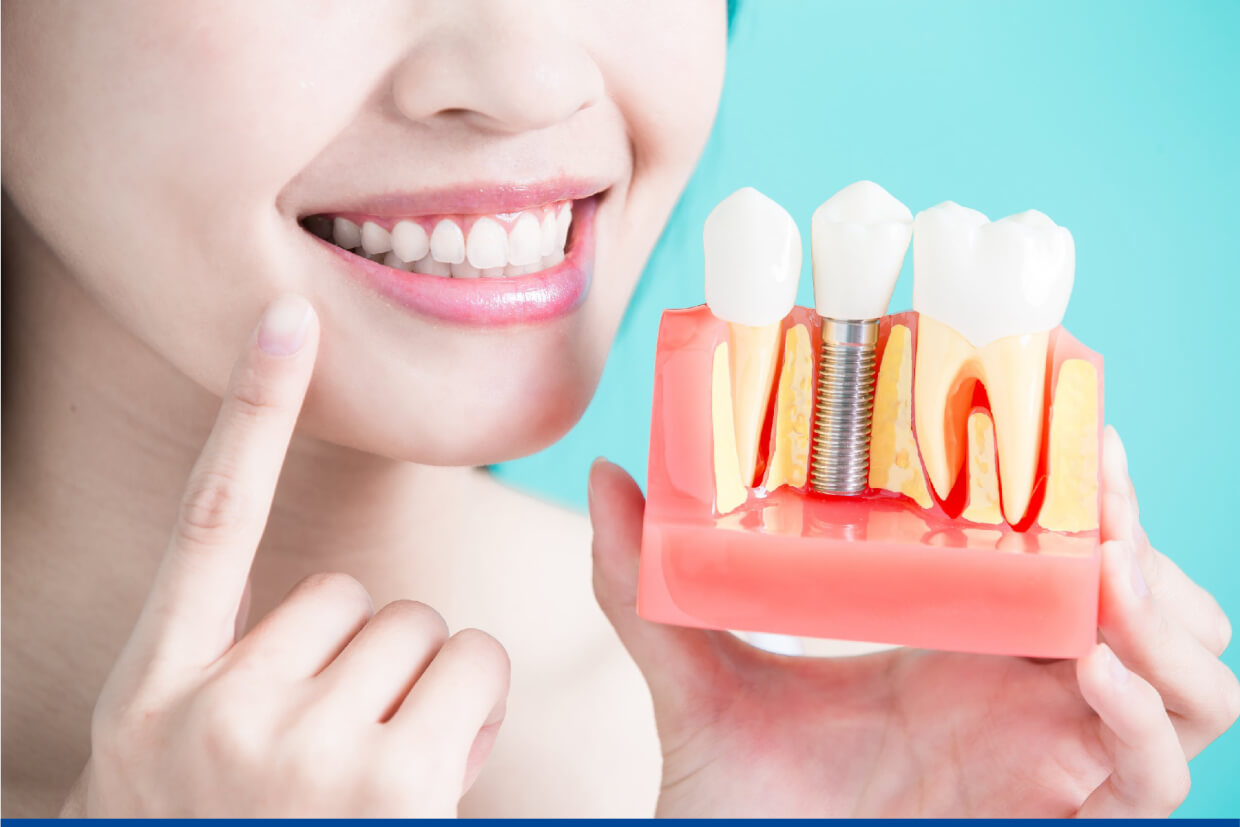 Dental Implant Cost In India 16561395210