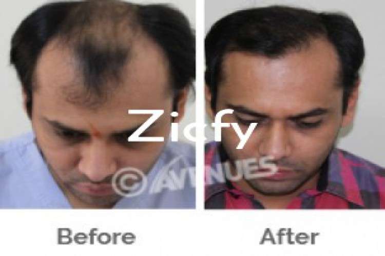 Get Natural Look That Lasts Forever After Transplant Starts From 40k 9635480