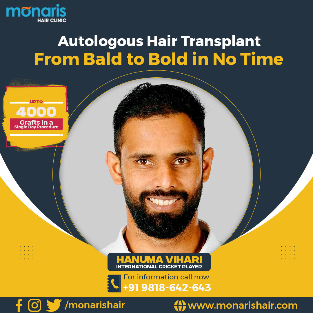 Hair Replacement In Delhi And Hair Transplant At Monaris 16667648647