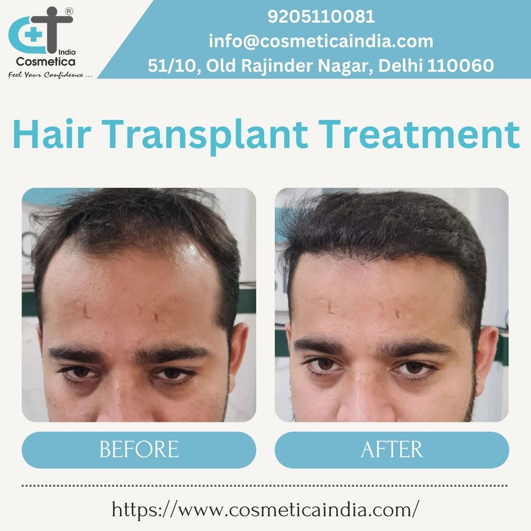 Hair Transplant Treatment 17302780516