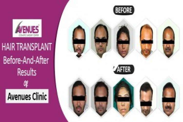 Look Younger With A Natural Looking Hair Transplant 6490143