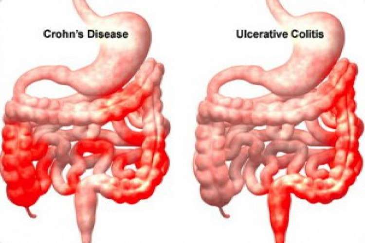 Low Cost Treatment For Ulcerative Colitis Without Any Colon Surgery 2474161