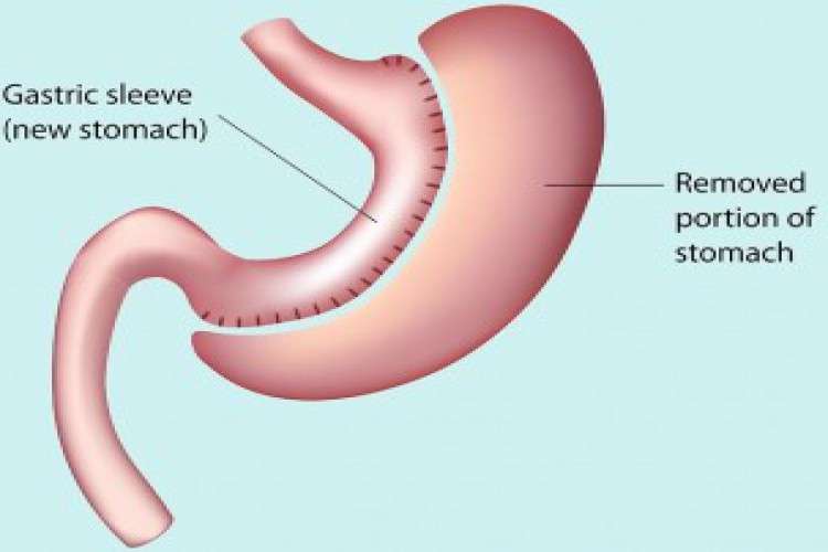 Sleeve Gastrectomy Bariatric Surgery In India 6549551