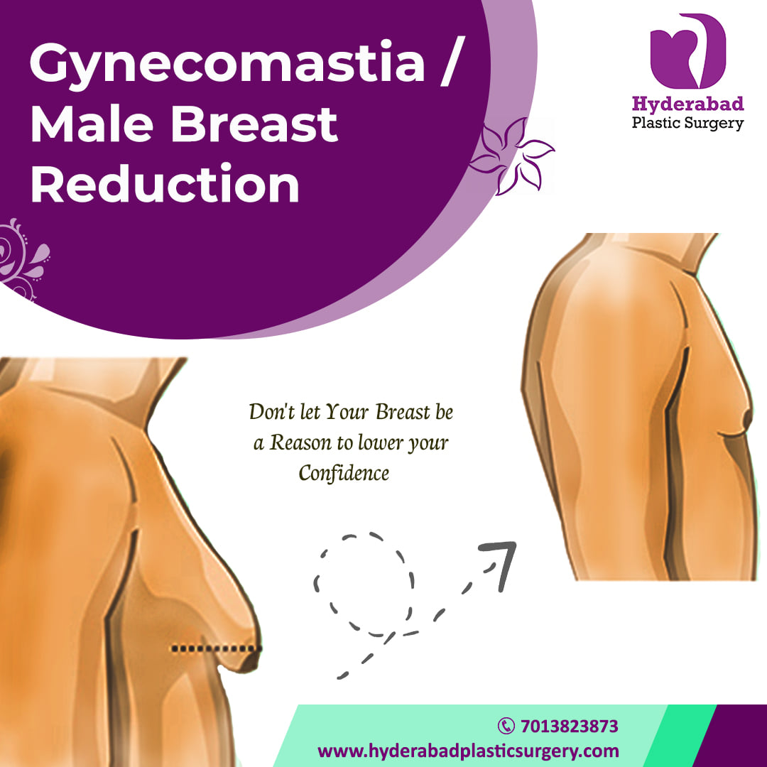 The Best Gynecomastia Surgery In Hyderabad 16742784112