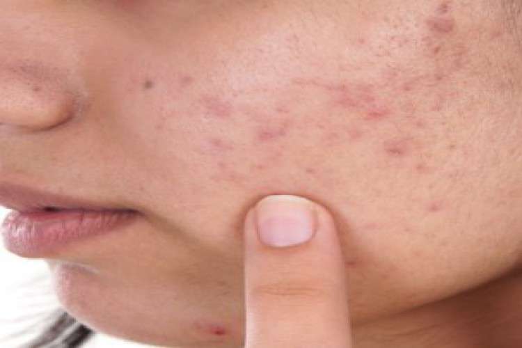 Top Five Clinics That Provide Laser Treatment For Acne Scars 3335031