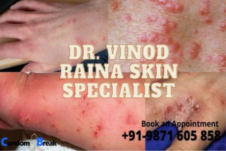 Treat Scabies Infection In Delhi By Dr Raina 4853830